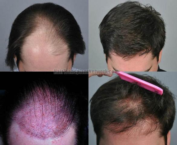 Top view before and after hair restoration results