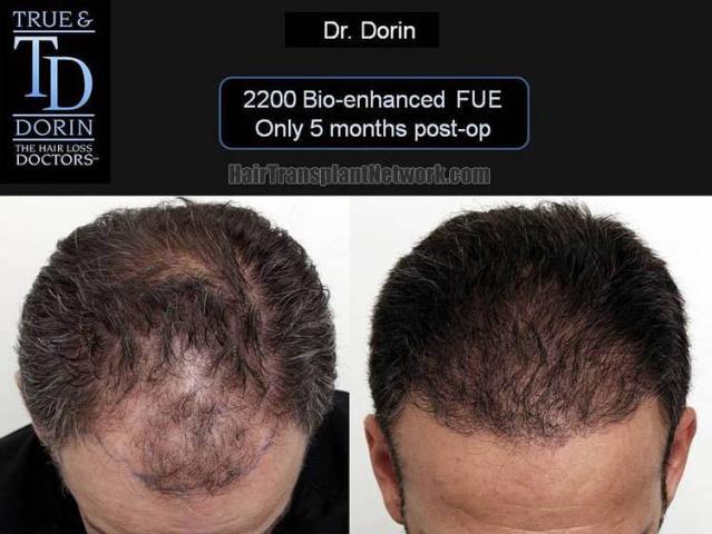 Hair restoration procedure before and after results