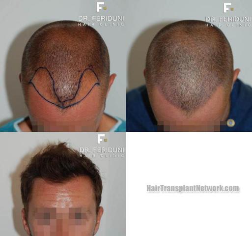 Top view before and after hair restoration results