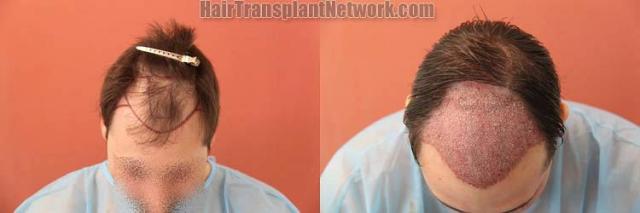 Hair transplantation surgery before and after images