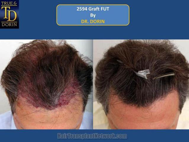 Hair restoration surgery before and after images