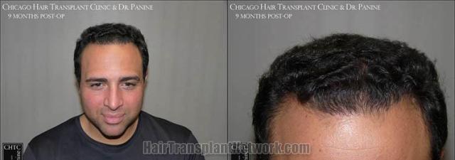 Hair restoration procedure before and after results