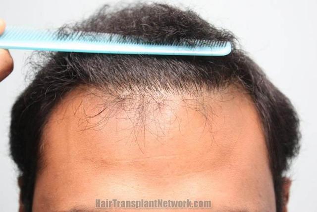 Hair transplantation surgery before and after photos