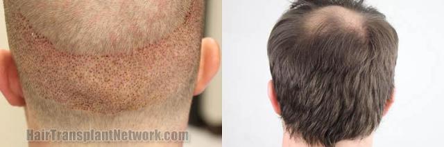 Hair restoration procedure before and after pictures