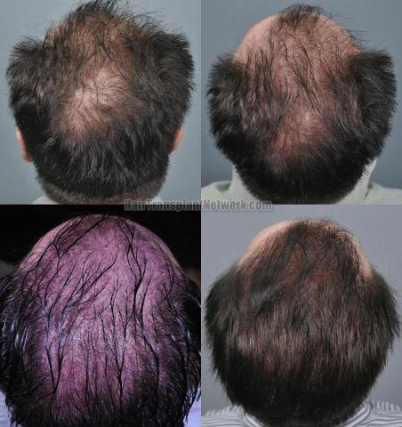 Hair restoration procedure before and after pictures