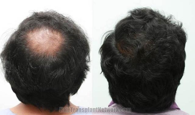 Hair transplantation surgery before and after images