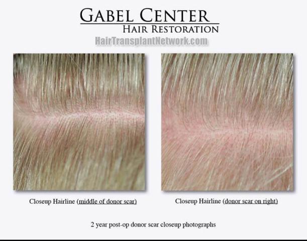 Surgical hair transplantation result photographs