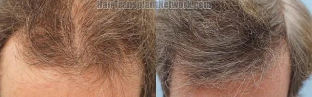 Hair restoration procedure before and after pictures