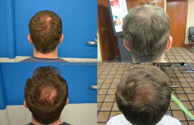 Hair transplantation surgery before and after images