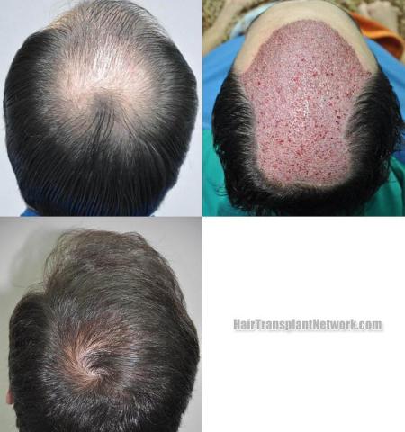 Hair transplantation surgery before and after images