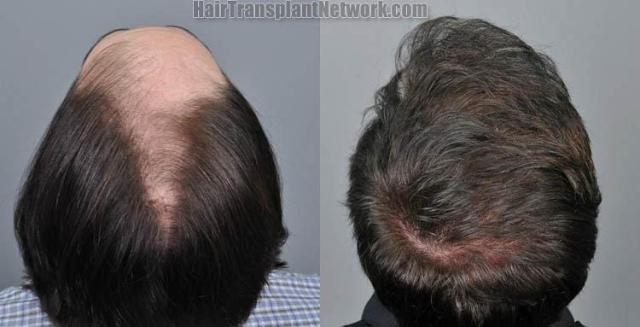 Hair replacement surgery before and after images