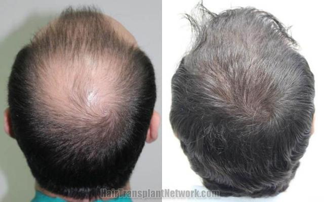 Hair restoration procedure before and after pictures