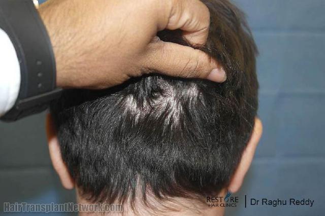 Hair restoration procedure before and after pictures