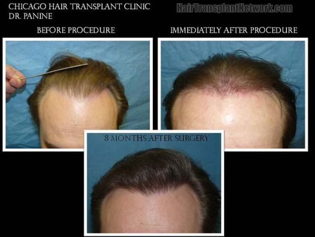 Before and after hair transplant procedure images