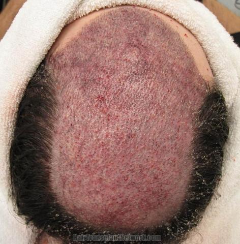 Hair transplantation surgery before and after images