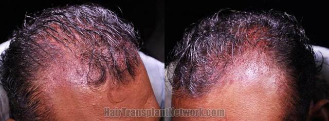 Hair transplantation surgery before and after pictures