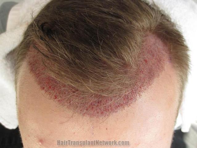 Hair restoration procedure before and after pictures