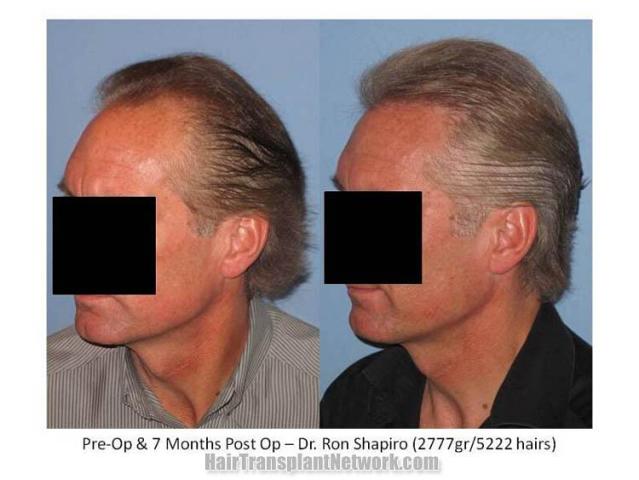 Hair restoration procedure results