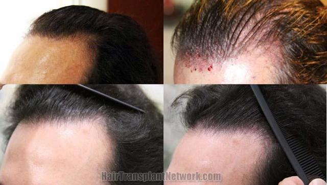 Hair restoration procedure before and after results