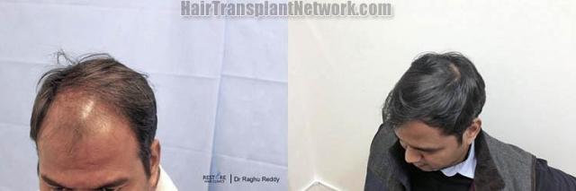 Hair transplantation surgery before and after pictures