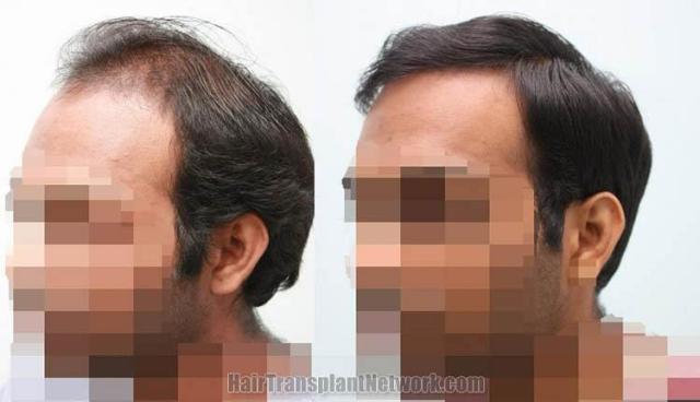 Hair transplantation surgery before and after images