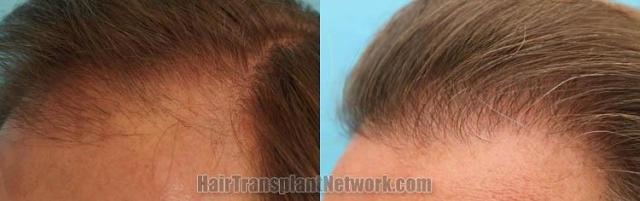 Hair transplantation surgery before and after photos