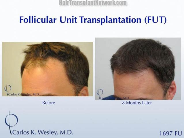 Hair transplantation surgery before and after pictures