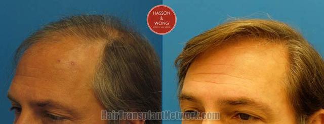 Hair transplantation surgery before and after pictures