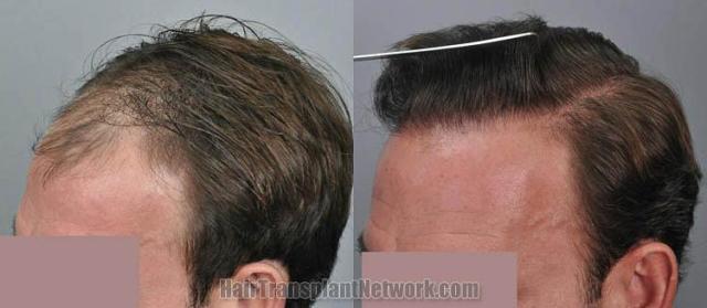 Hair transplantation surgery before and after images