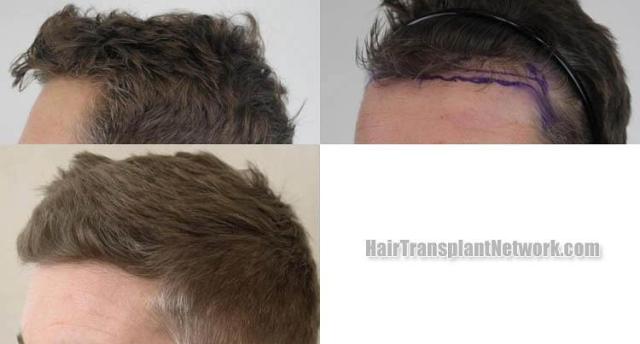 Hair transplantation surgery before and after pictures