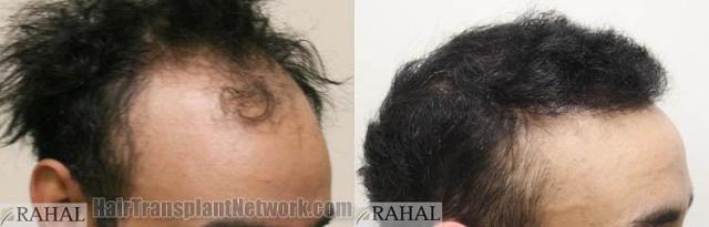 Hair restoration procedure before and after results