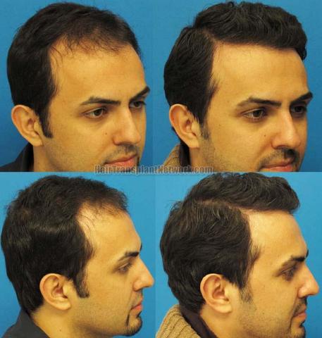 Hair transplantation surgery before and after images