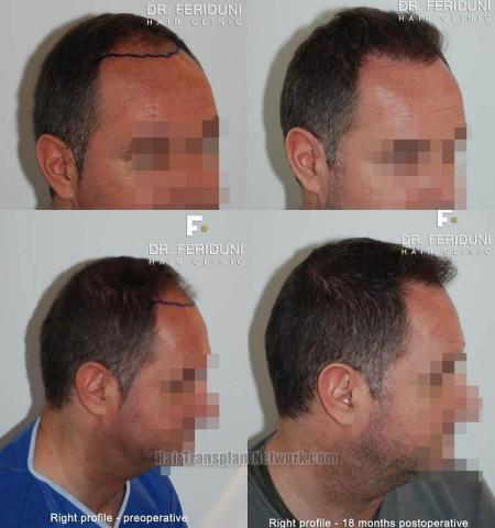 Hair transplantation surgery before and after images