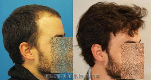 Before and after hair transplantation result photographs