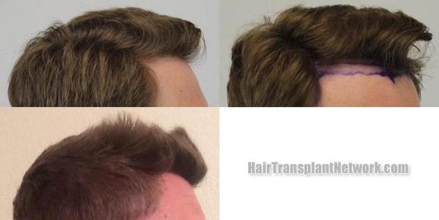 Hair transplantation surgery before and after photos