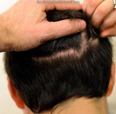 Surgical hair transplantation result photographs