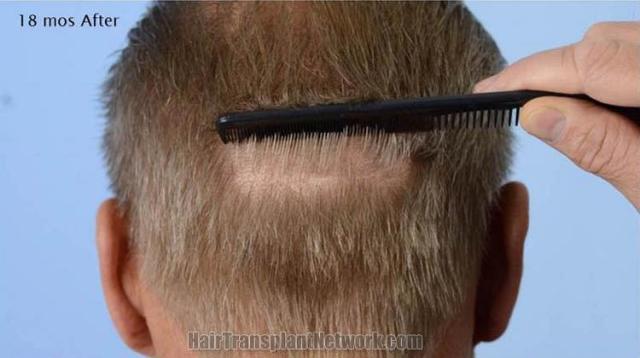 Hair transplantation surgery 18 months after image