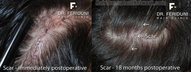 Hair restoration procedure before and after pictures