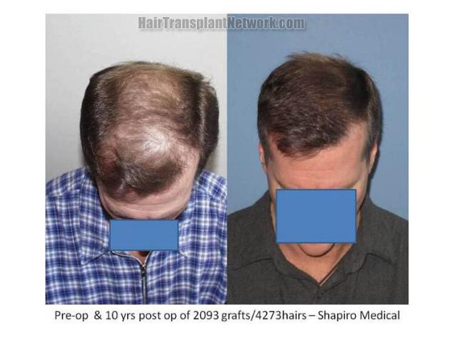 Tilt down view before and after hair restoration