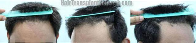 Hair transplantation surgery before and after pictures