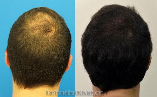 Hair transplantation surgery before and after pictures