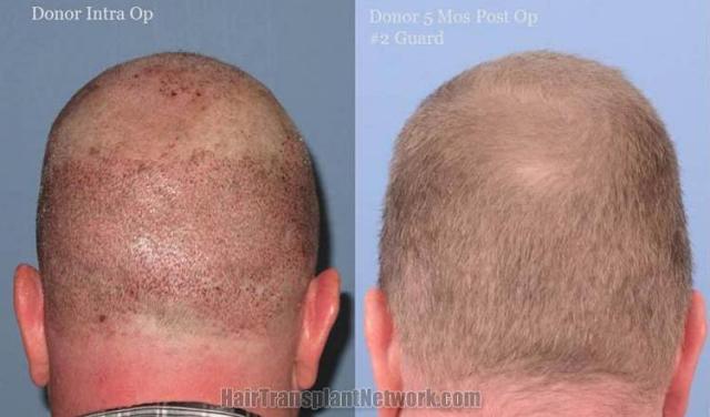 Hair restoration procedure before and after pictures