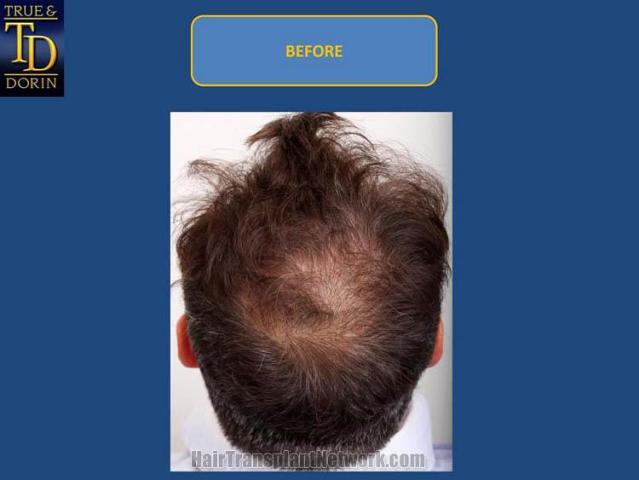 Hair restoration procedure before and after pictures