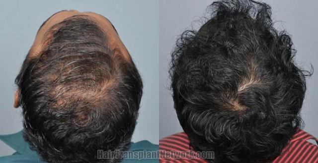 Hair transplantation surgery before and after images