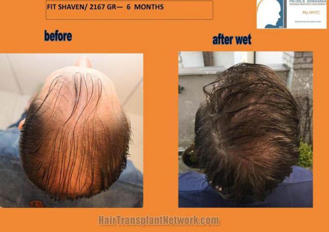 Hair restoration procedure before and after pictures