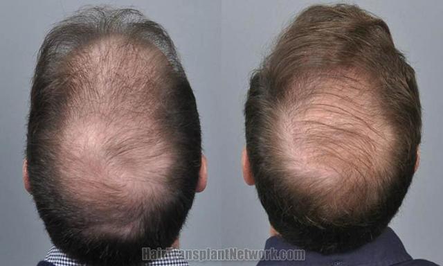 Hair transplantation surgery before and after images