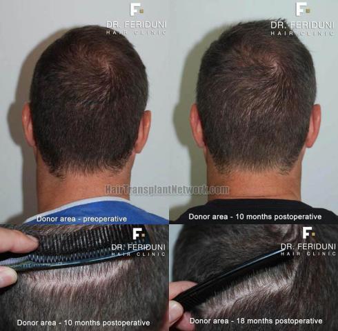 Hair restoration procedure before and after pictures