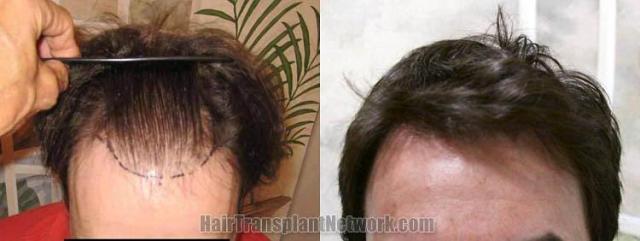 Hair restoration procedure before and after results