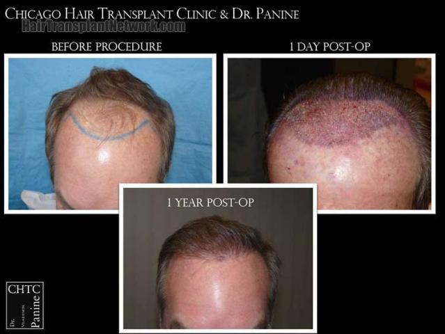 Hair restoration procedure before and after pictures