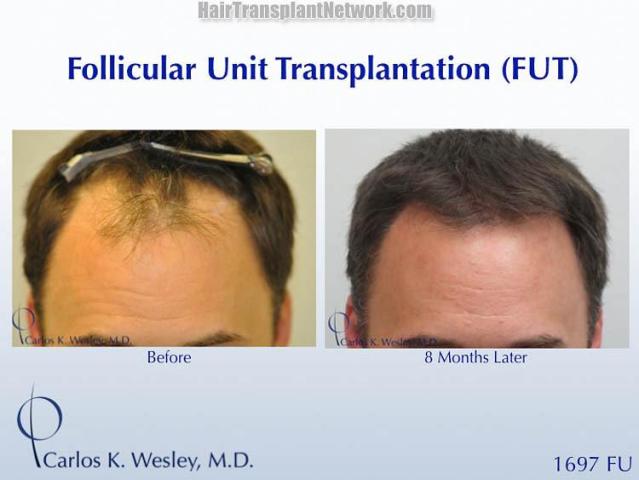 Hair restoration procedure before and after results